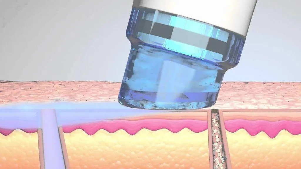Воздействие HydraFacial на кожу