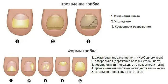 формы поражения ногтя грибковыми заболеваниями