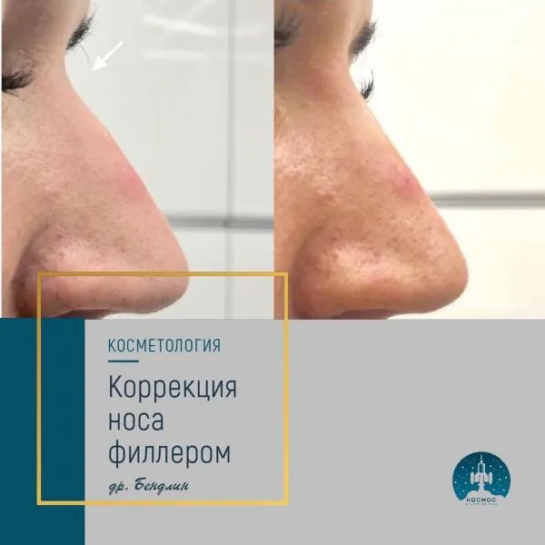 Нос