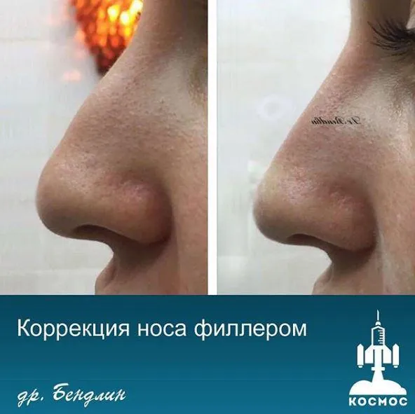 Нос