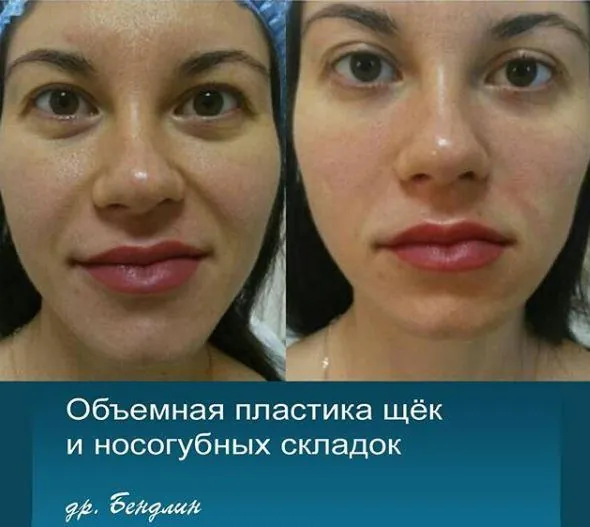 Скулы