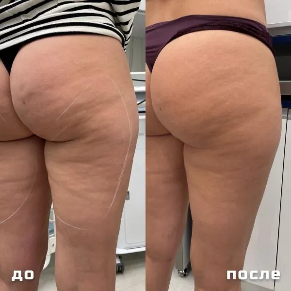 Ультразвуковая кавитация