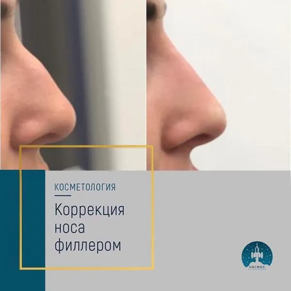 Нос