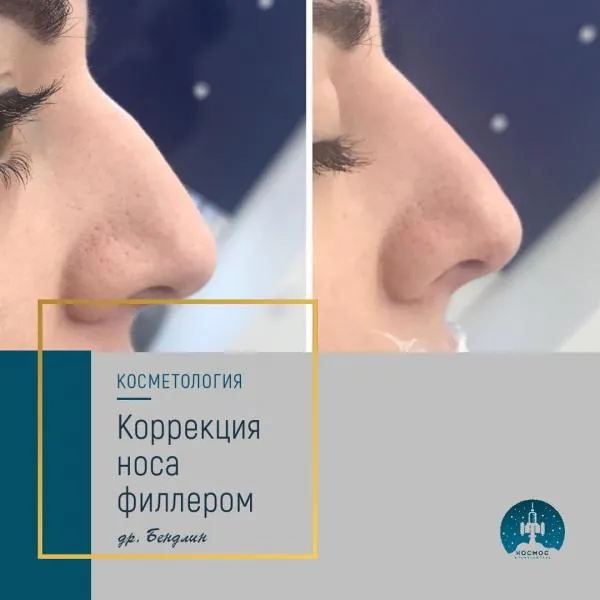 Нос
