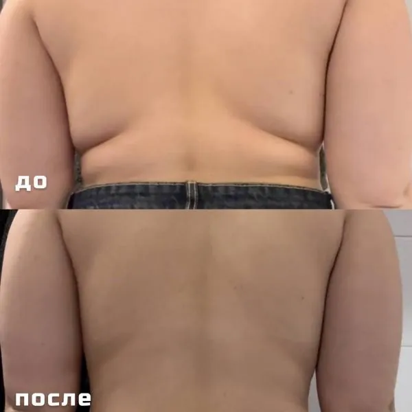 Ультразвуковая кавитация