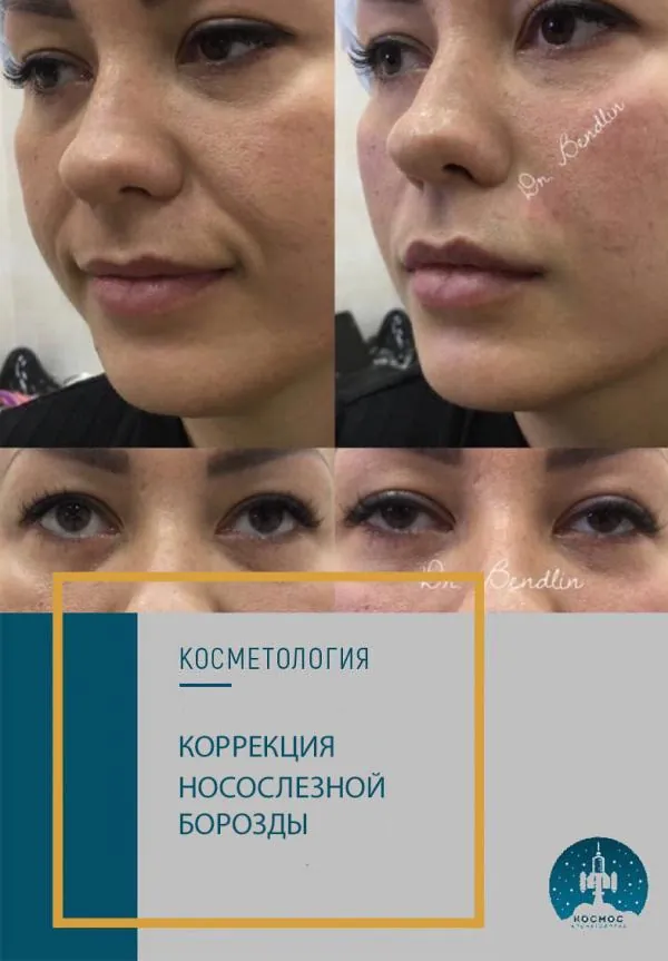 Носослезная борозда