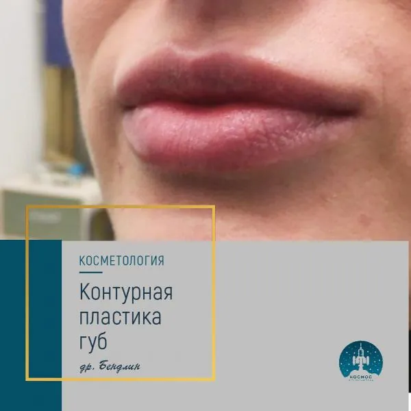 Увеличение губ - фотографии работ до и после процедуры
