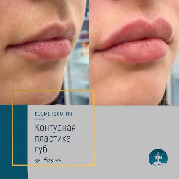 Увеличение губ - фотографии работ до и после процедуры