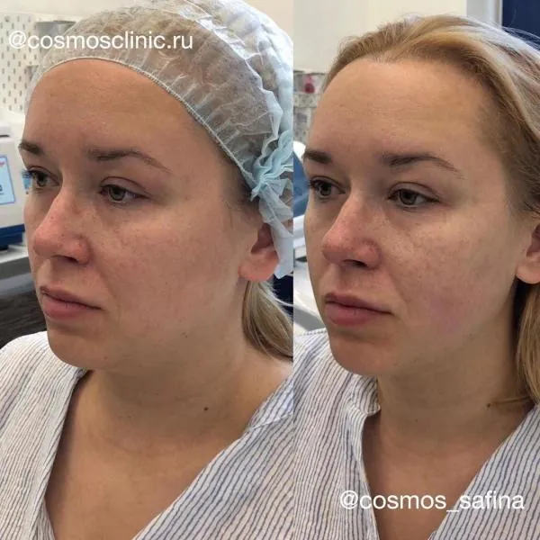Фотографии до и после процедур