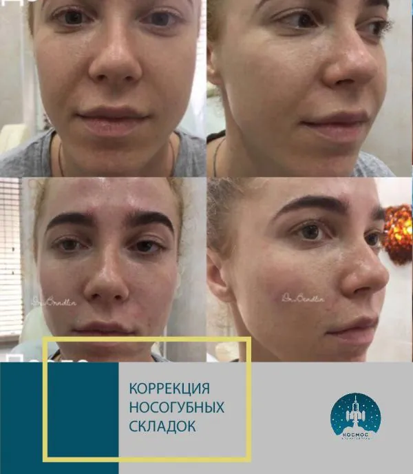 Фото до и после
