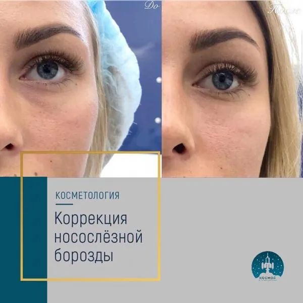 Носослезная борозда