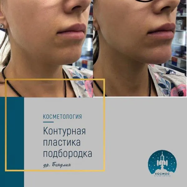 Подбородок