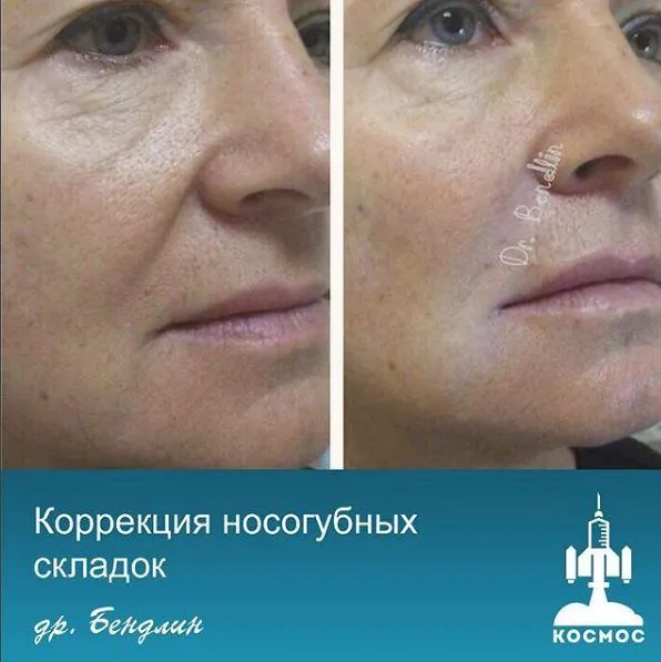 Носогубные складки