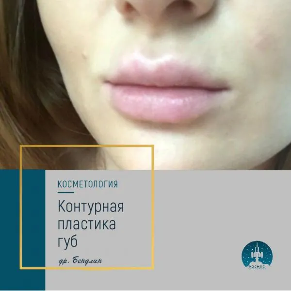 Увеличение губ - фотографии работ до и после процедуры