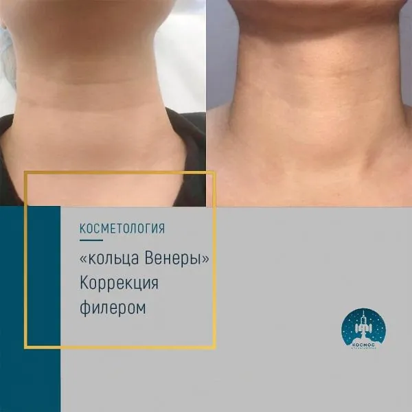 Шея