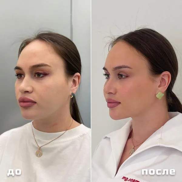 SMAS-лифтинг