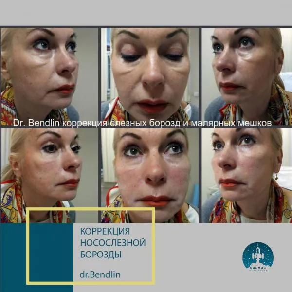 Носослезная борозда