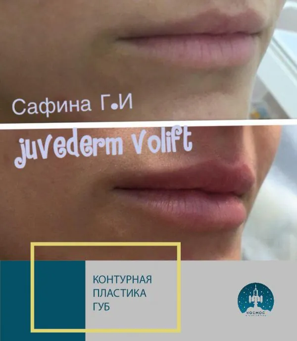 Увеличение губ - фотографии работ до и после процедуры