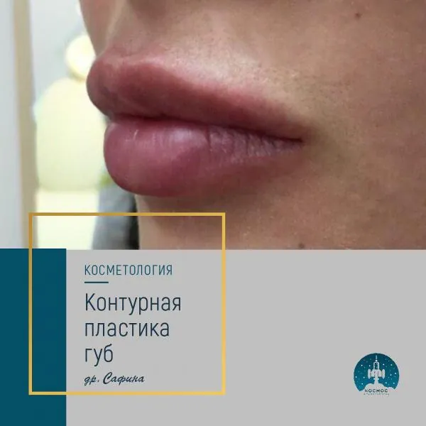 Увеличение губ - фотографии работ до и после процедуры