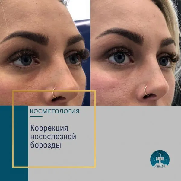 Носослезная борозда