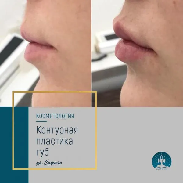 Увеличение губ - фотографии работ до и после процедуры