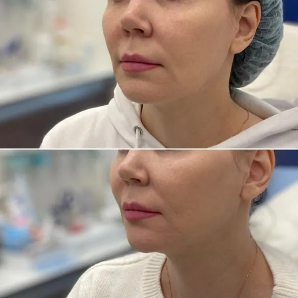 Увеличение губ - фотографии работ до и после процедуры