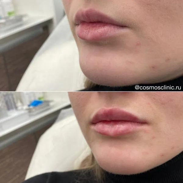 Увеличение губ - фотографии работ до и после процедуры
