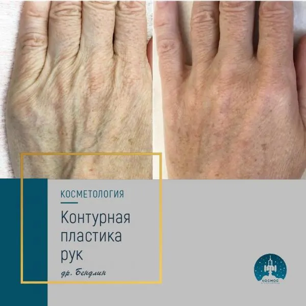 Руки
