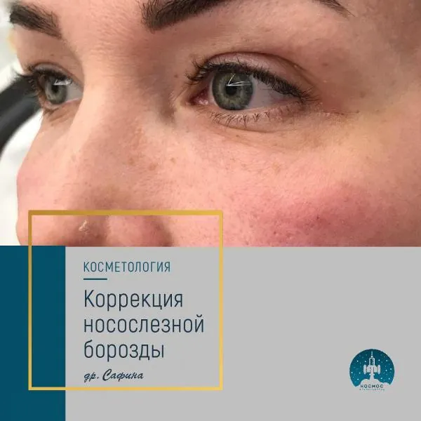 Носослезная борозда