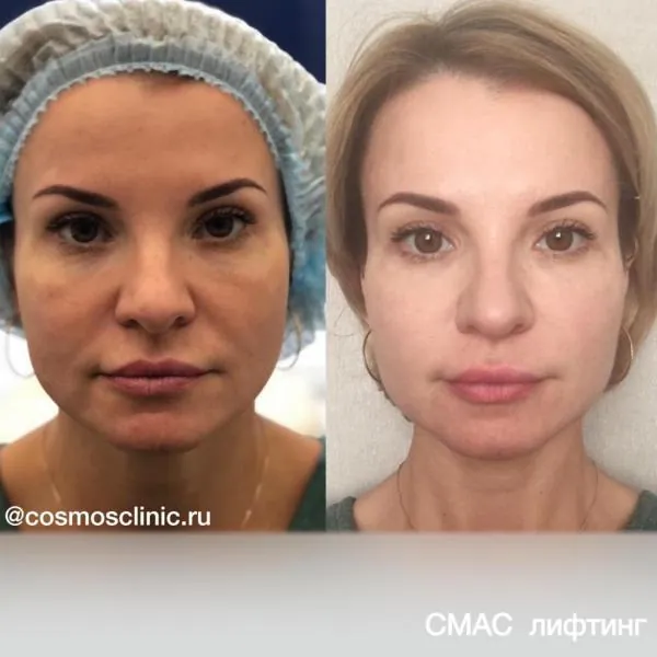 SMAS-лифтинг