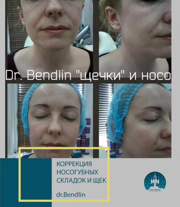 Носогубные складки