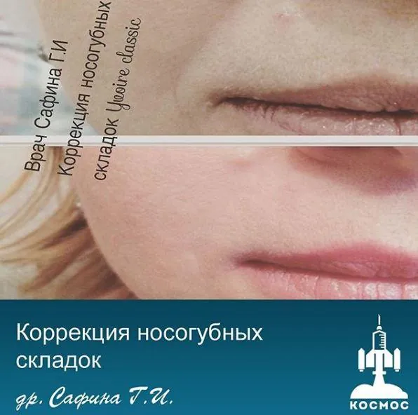 Носогубные складки