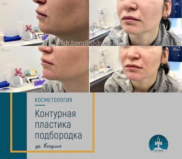 Подбородок