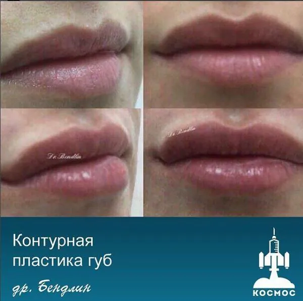 Увеличение губ - фотографии работ до и после процедуры