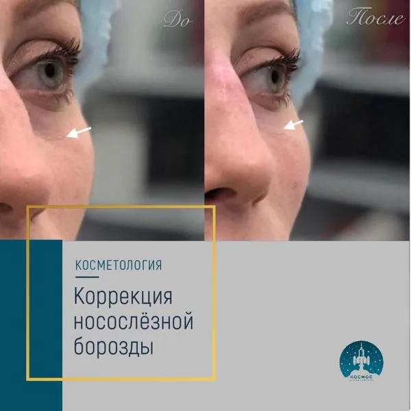 Носослезная борозда