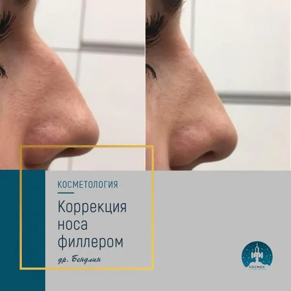 Нос