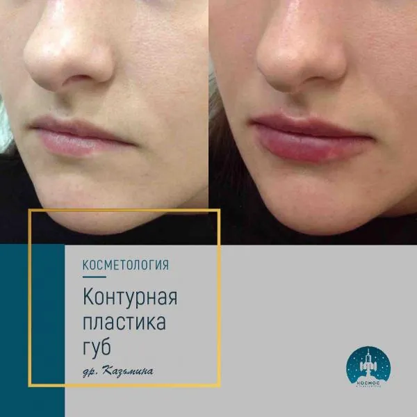 Увеличение губ - фотографии работ до и после процедуры