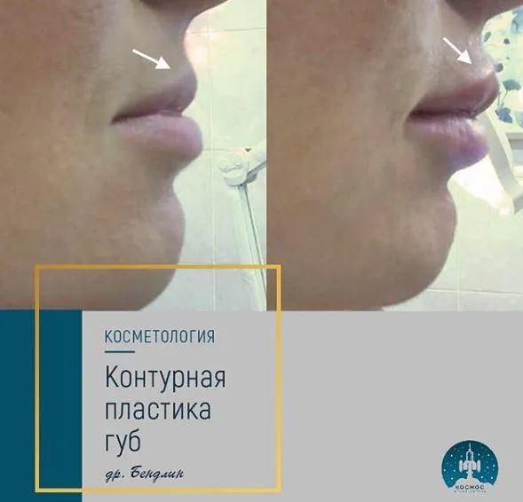 Увеличение губ - фотографии работ до и после процедуры