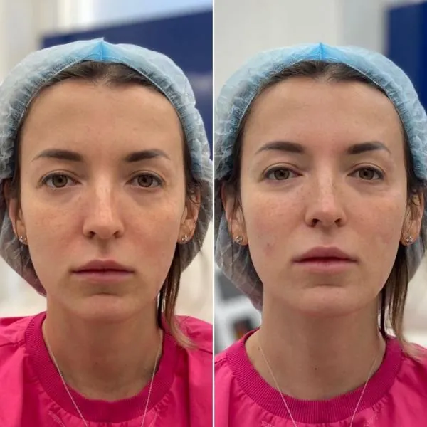 Увеличение губ - фотографии работ до и после процедуры