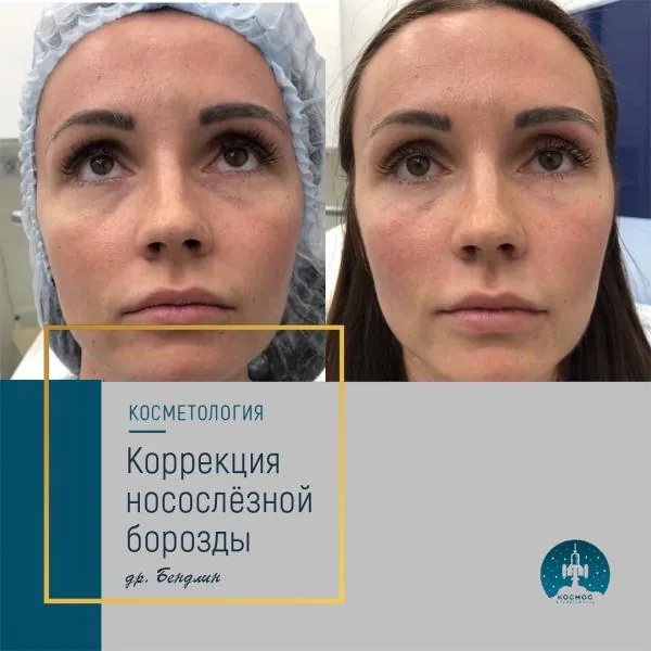 Носослезная борозда