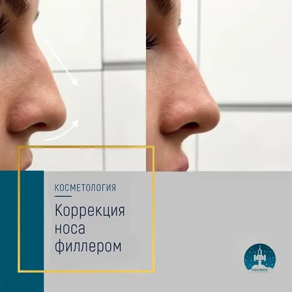 Нос