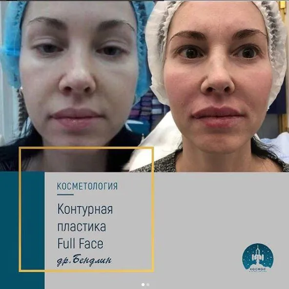 Носогубные складки
