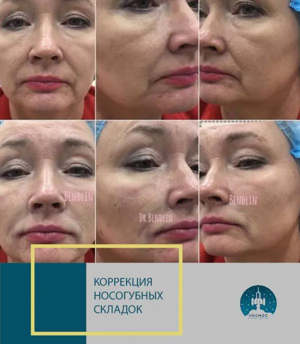Фото до и после