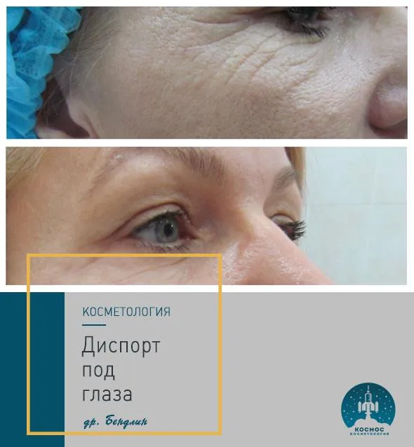 Контурная пластика