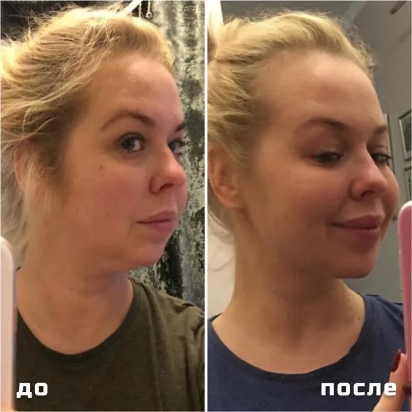 SMAS-лифтинг