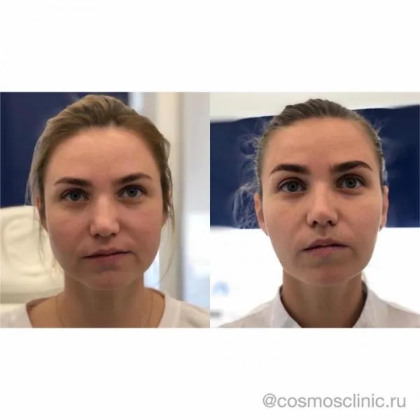 SMAS-лифтинг