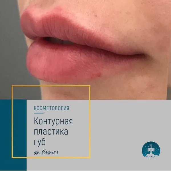 Увеличение губ - фотографии работ до и после процедуры