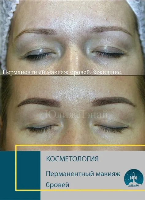 До и после процедуры