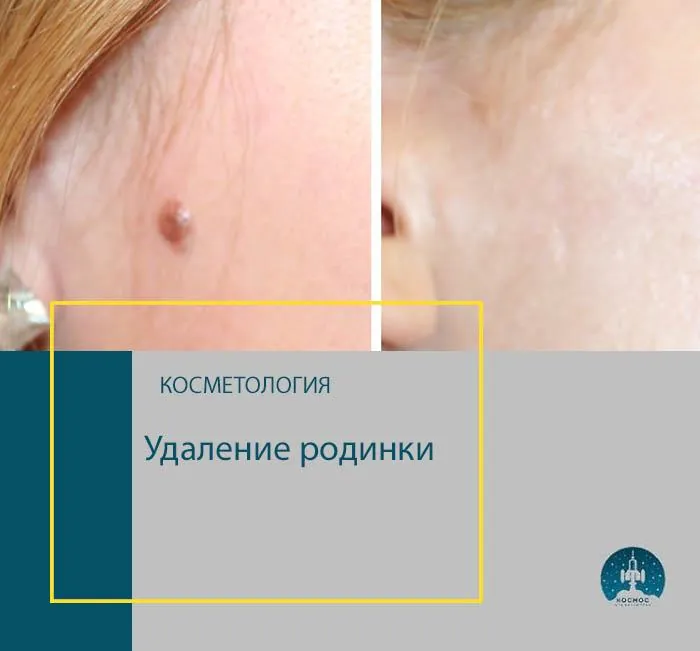 До и после процедуры