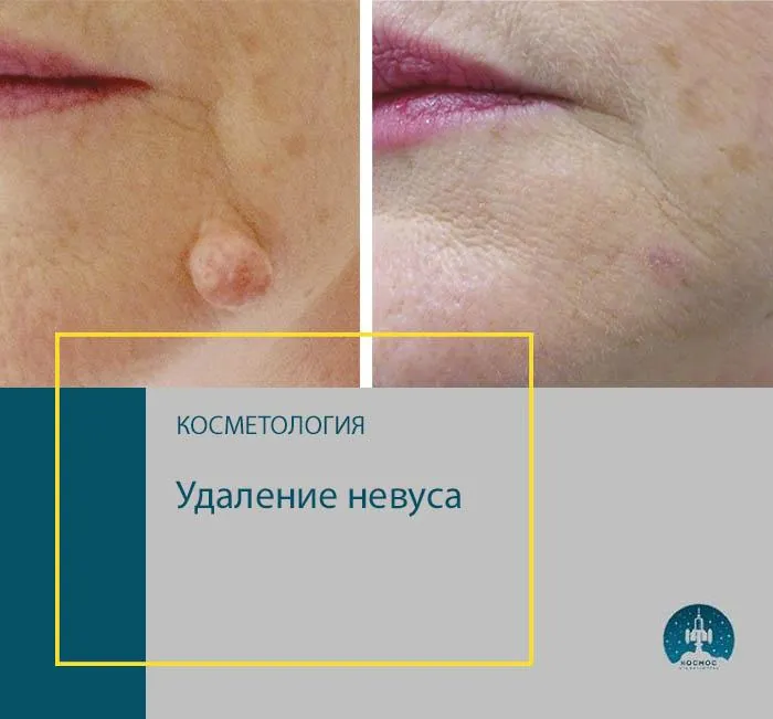 До и после процедуры